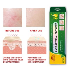 Factory Price Skin Itching Antipruritic Psoriasis Eczema Dermatitis Cream