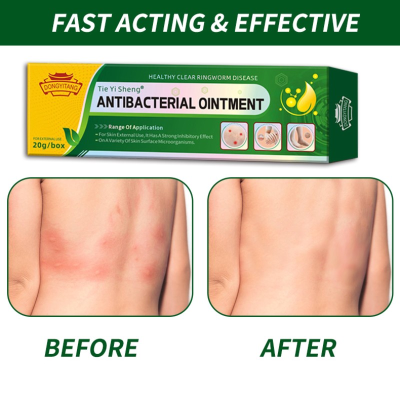 Topical Skin Infection Care Cream Skin Itching Eczema Soothing Balm