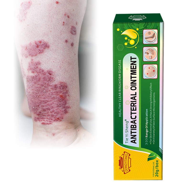 Factory Supply Local Skin Infection Eczema Cream Skin Antipruritic Cream