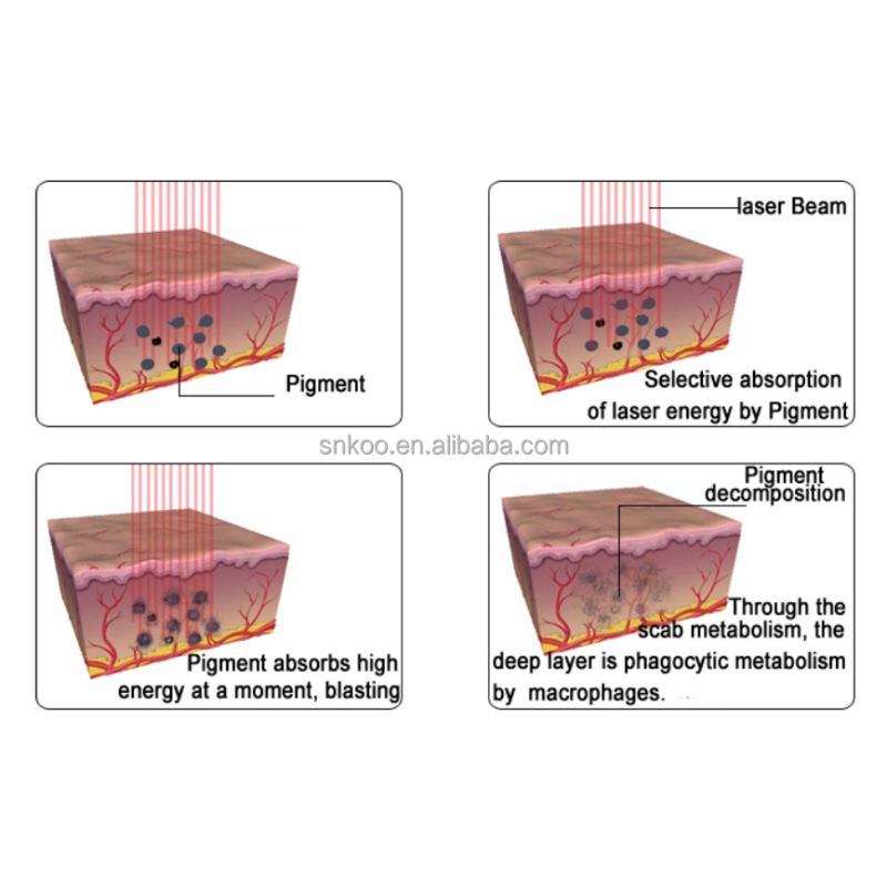 CE Approved  1200W RF Nd Yag Laser OPT Magneto-Optical for Hair Removal and Skin Rejuvenation