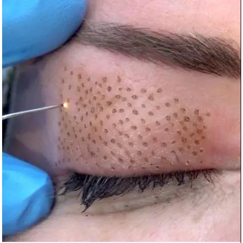 New Technology Snkoo 3 in 1Professional Plasma Surface Hower Eyelid Lifting Treatment Plasma Surgical Wrinkle Removal Machine