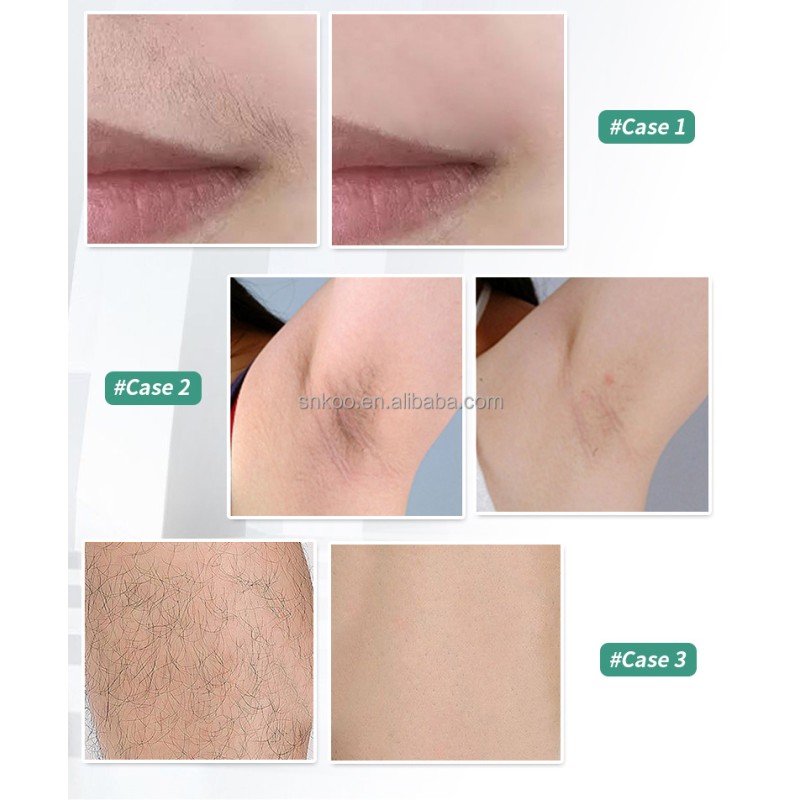 Factory Price OPT Hair Removal Skin Rejuvenation OPT Laser Hair Removal Machine