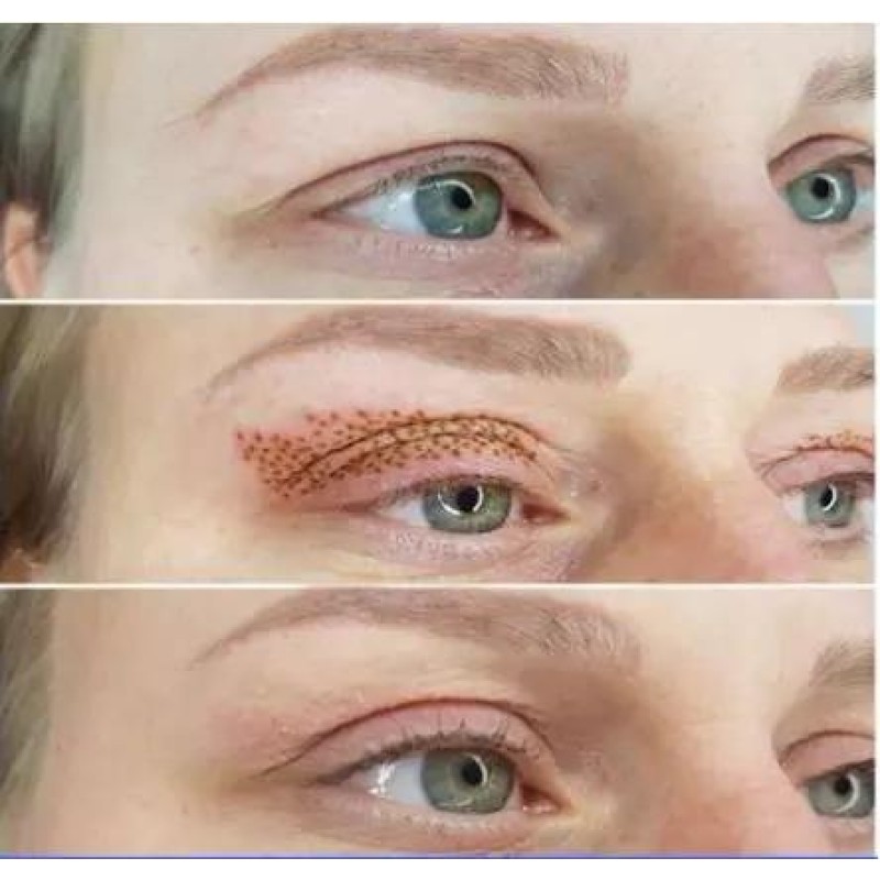 New Technology Snkoo 3 in 1Professional Plasma Surface Hower Eyelid Lifting Treatment Plasma Surgical Wrinkle Removal Machine