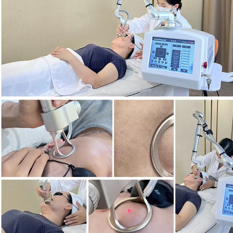 2025 RF Tube Fractional Co2 Laser for Skin and Vaginal 60W