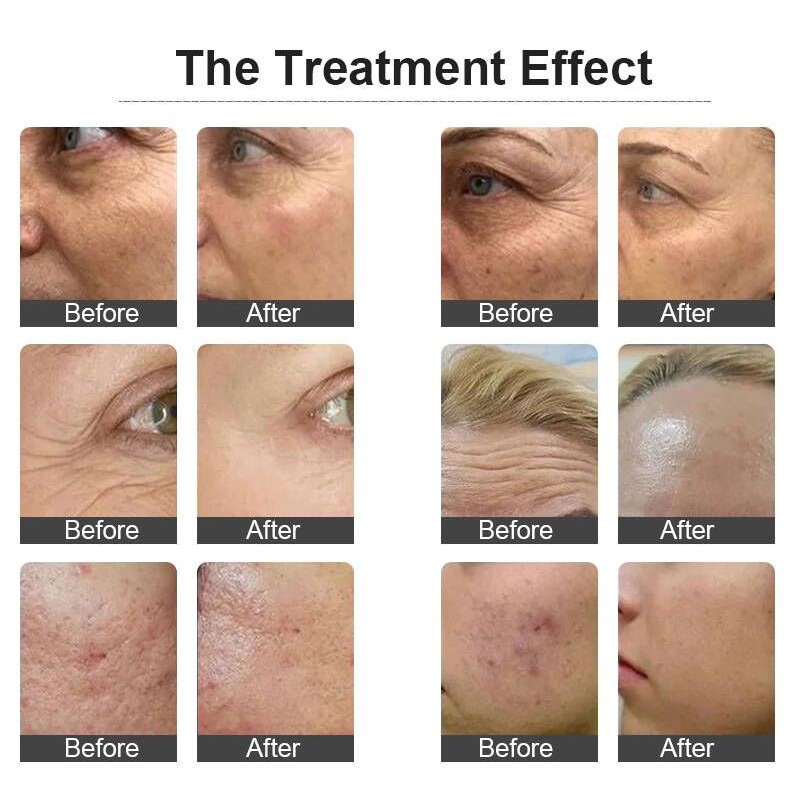 Radio Frequency RF Microneedle Beauty Portable Skin Tightening Machine Gold Fractional Rf Microneedling Machine