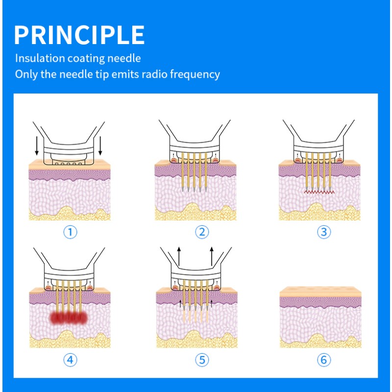 Professional Portable Radio Fractional Rf  Microneedling  Fractional Machine for Stretch Marks Removal