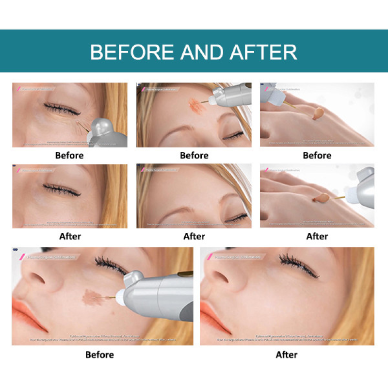 New Technology Snkoo 3 in 1Professional Plasma Surface Hower Eyelid Lifting Treatment Plasma Surgical Wrinkle Removal Machine