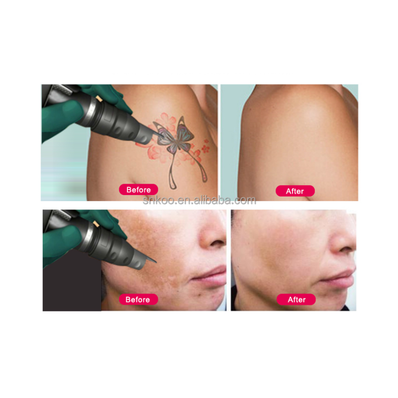 CE Approved  1200W RF Nd Yag Laser OPT Magneto-Optical for Hair Removal and Skin Rejuvenation