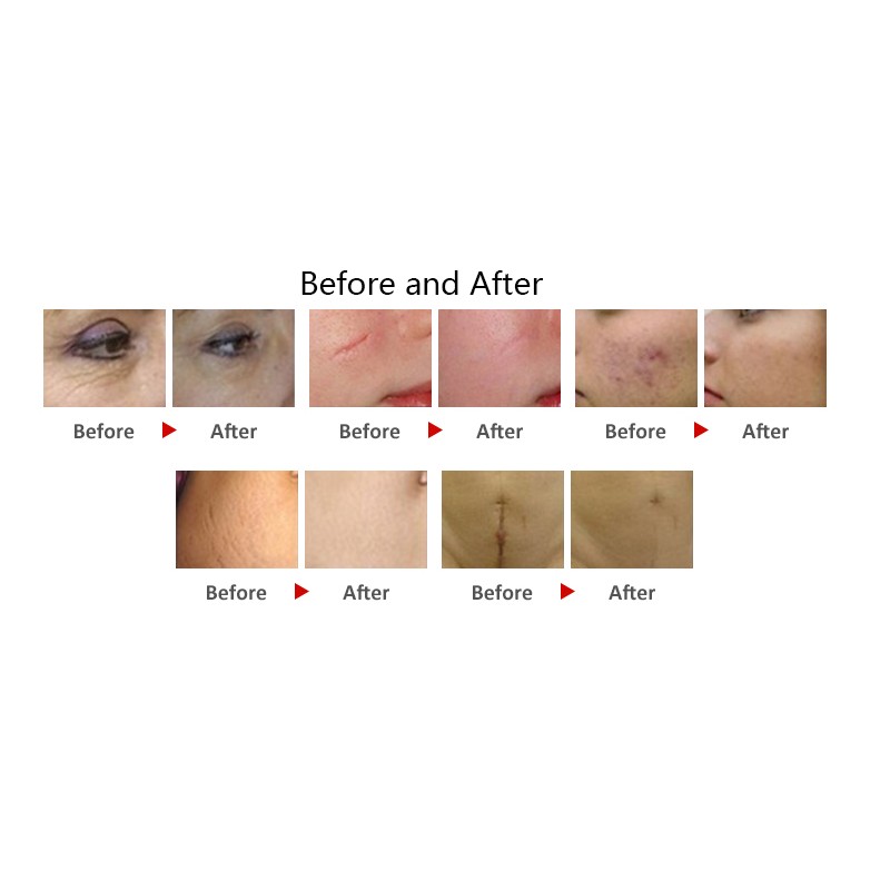 Hot Sales Nd-Yag Pico Pigmentation Removal Machine Beauty Salon Tattoo Removal Nd Yag Picosecond Laser