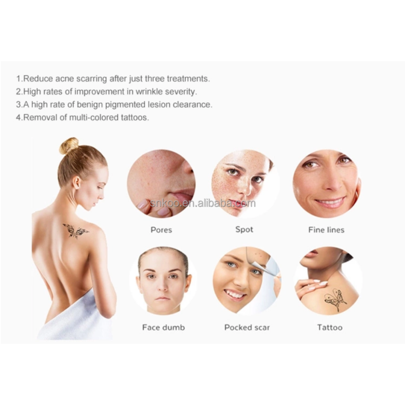 CE Approved  1200W RF Nd Yag Laser OPT Magneto-Optical for Hair Removal and Skin Rejuvenation