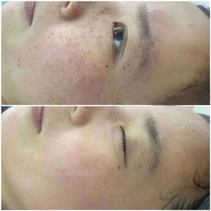 Best Selling 3 Wavelength Diode Laser Picosecond Pigmentation Removal Tattoo Removal Machine