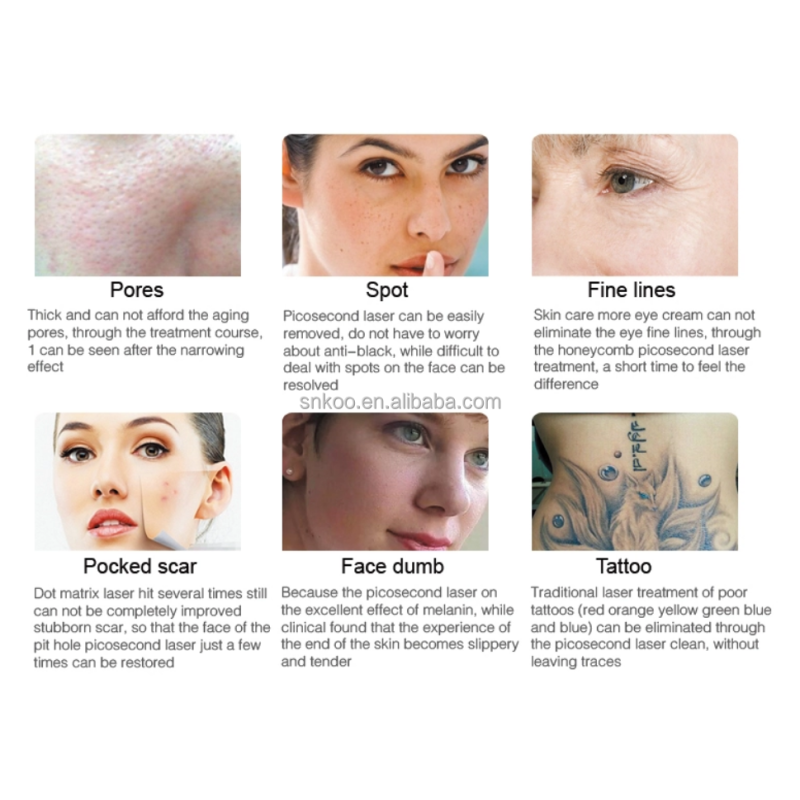 RF Tube Most Popular Skin Resurfacing Co2 Fractional Laser Machine for Beauty and Medical Use