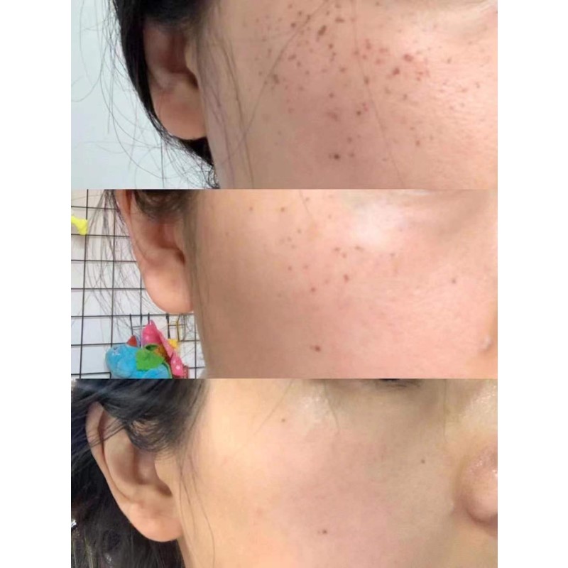 Vertical Pigment Treatment Picosecond 1064+532+755nm Laser Tattoo Removal Pico Laser Machine