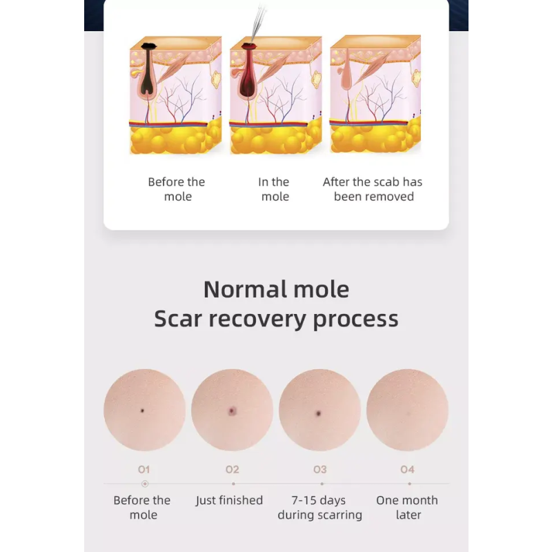 New Cold Plasma Pen Tag Remover Professional Plasma Pen Beauty Mole Removal Sweep Spot Pen