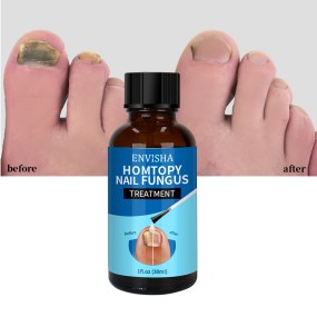 Nail Treatment Oil Factory - Foot Soften Ingrown Toenail Drops