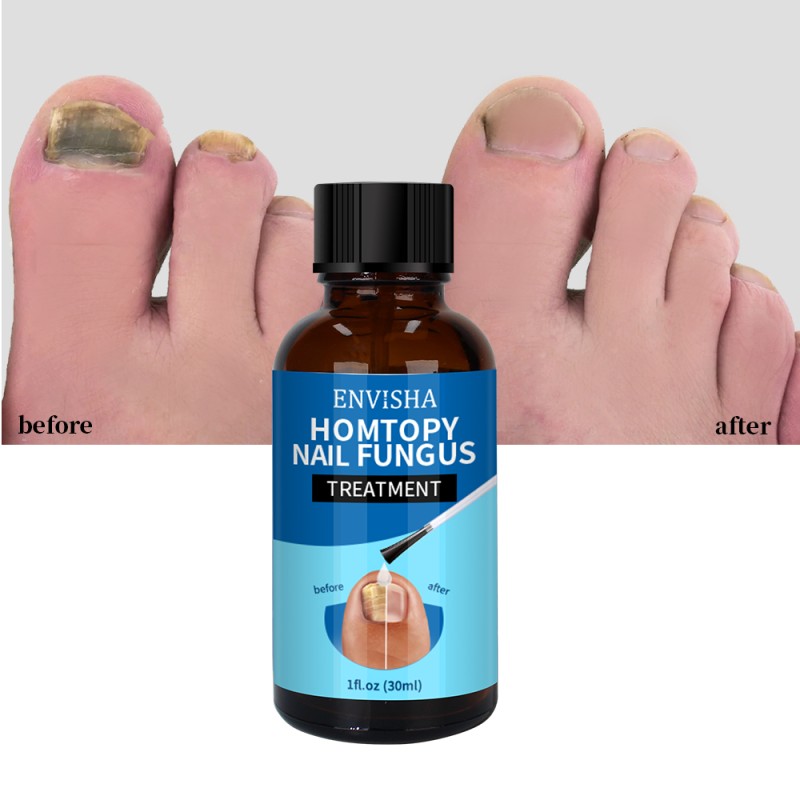 Nail Treatment Oil Factory - Foot Soften Ingrown Toenail Drops