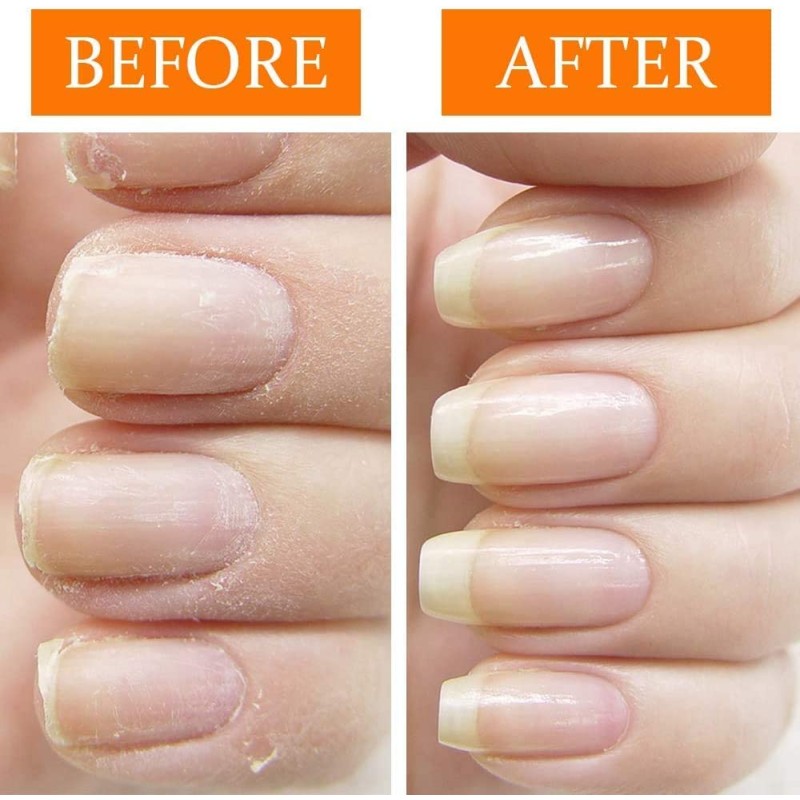 Nail Gel Manufacturer - Fungal Treatment Whitening Removal Gel