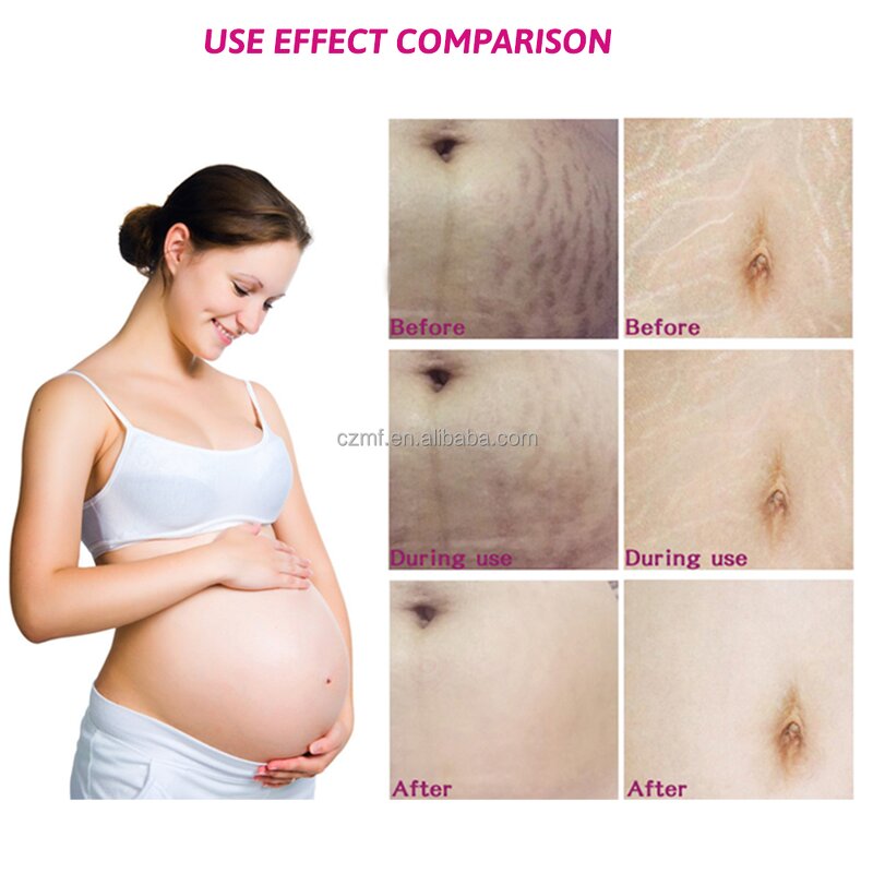 Stretch Mark Cream Manufacturer - OEM/ODM Wholesale Private Label Natural Organic