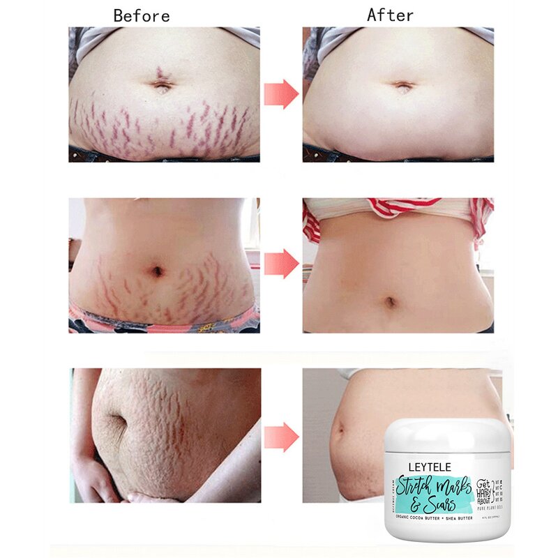 Stretch Mark Oil Cream Manufacturer - OEM/ODM Private Label Best Natural Body Care