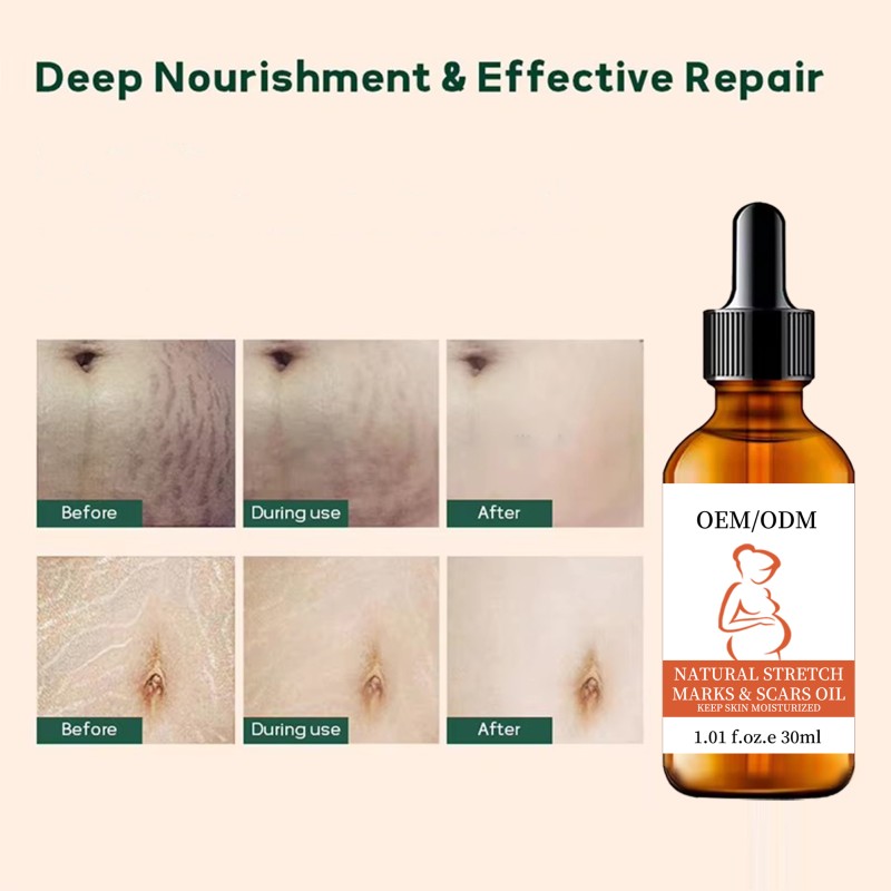 Stretch Mark Lotion Factory - Organic Essential Oil Scar Care