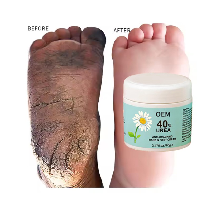 Foot Cream Manufacturer - OEM Urea Peptide Foot Care Repair Lotion