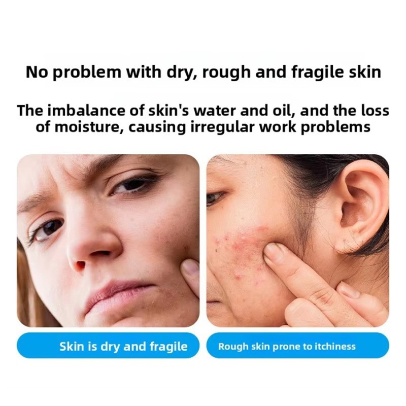 Face Cream Factory - OEM Custom B5 Acne Treatment Soothing