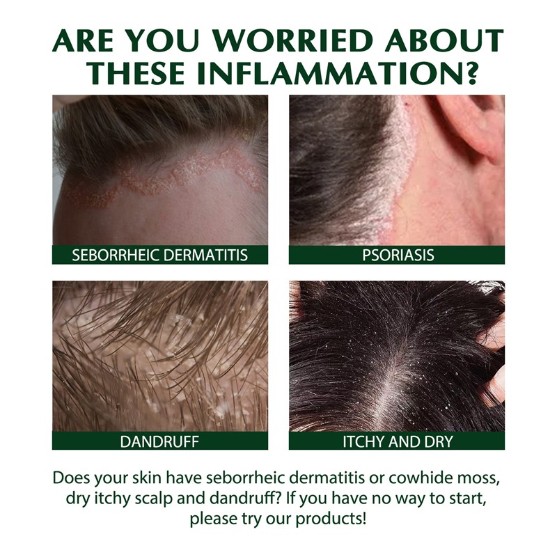 Hair Shampoo Manufacturer - OEM Private Label Anti Dandruff Seborrheic Dermatitis