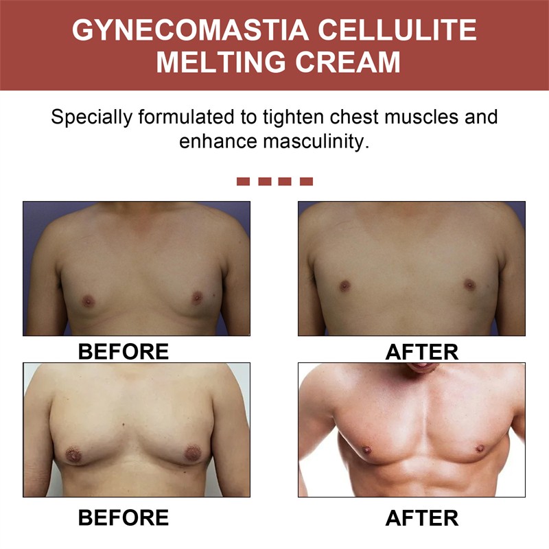 Male Breast Cream Manufacturer - OEM South Moon Gynecomastia Cellulite Melting Chest
