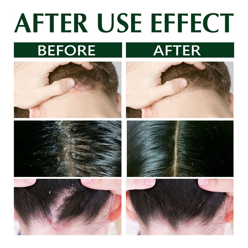 Hair Shampoo Manufacturer - OEM Private Label Anti Dandruff Seborrheic Dermatitis