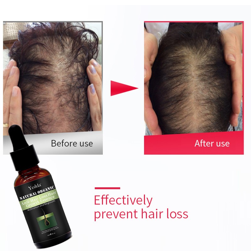 Hair Loss Treatment Oil - Organic Biotin Serum