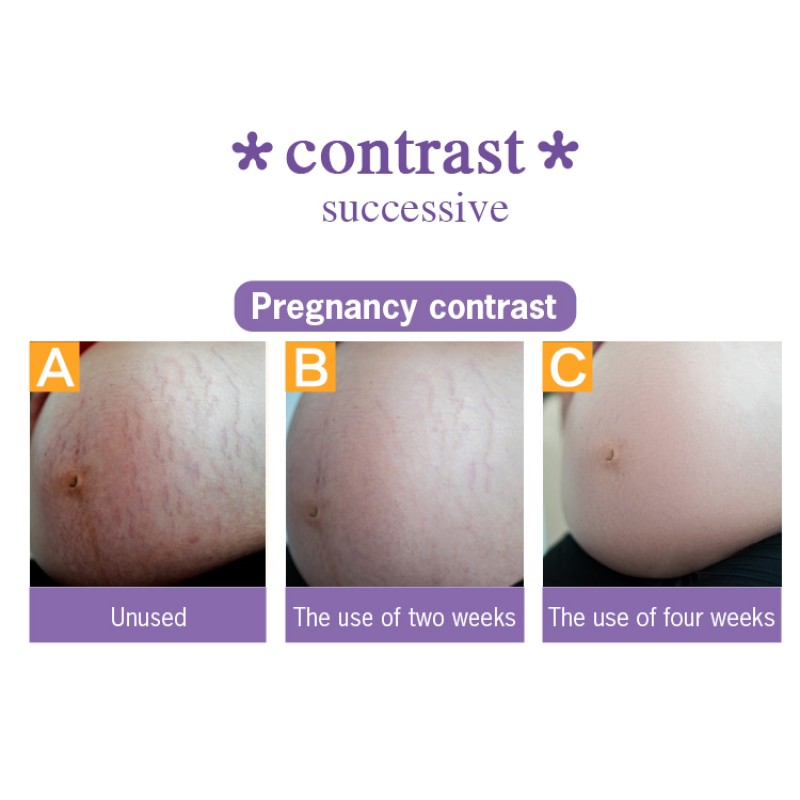 Stretch Mark Cream - 250ml Cosmetics Grade