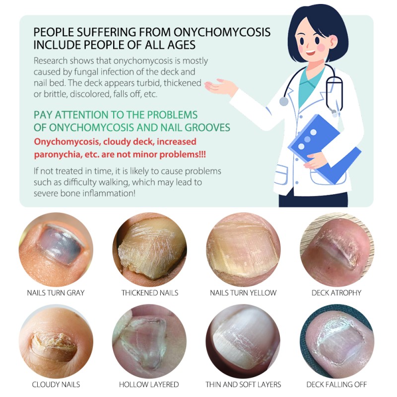 Ginger Extract Paronychia Nail Essence Treatment Fungus Damaged Fingernail Repair Anti Bacterial Nail Serum