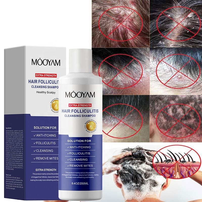 Anti Acne Extra Strength Hair Folliculitis Cleansing Shampoo Folliculitis Shampoo Seborrheic Dermatitis Shampoo