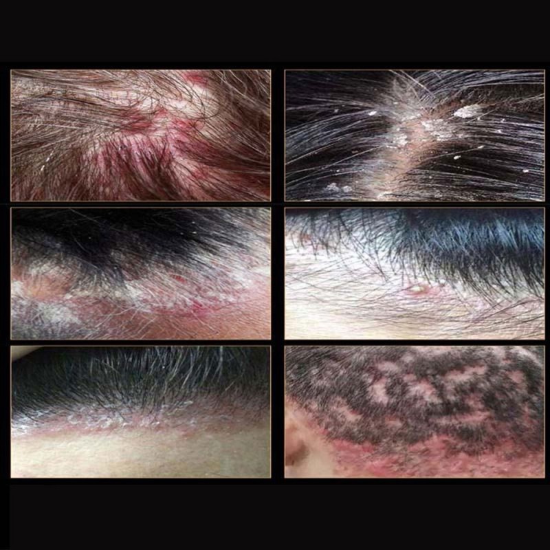 Anti Acne Extra Strength Hair Folliculitis Cleansing Shampoo Folliculitis Shampoo Seborrheic Dermatitis Shampoo