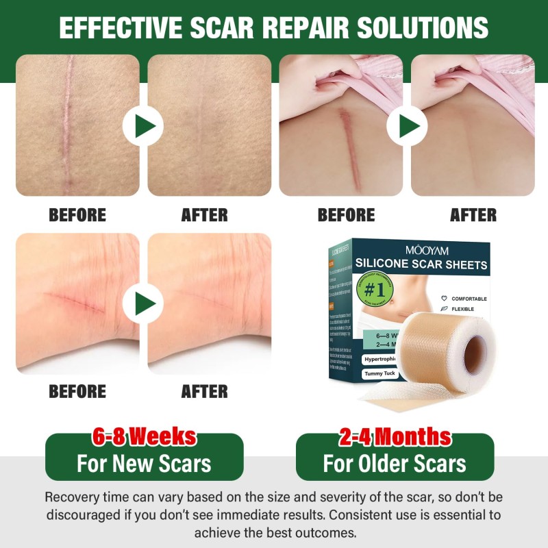 Private Label Scar Keloid Bump Removal Tape Silicone Scar Sheets for Surgical Scars (1.6"x 60" Roll-1.5M)