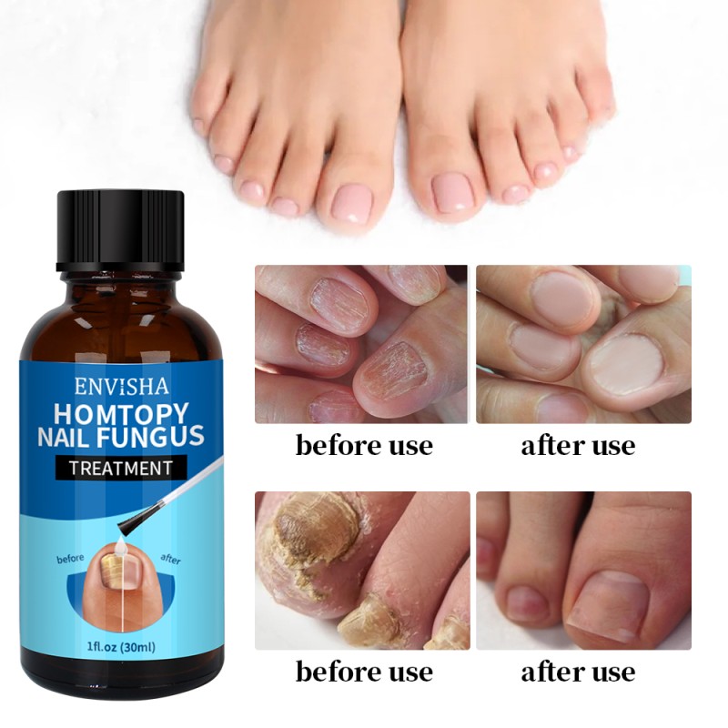 Nail Repair Serum Factory - Wholesale 30ml Fungal Nail Repair Serum Toenail Treatment Oil