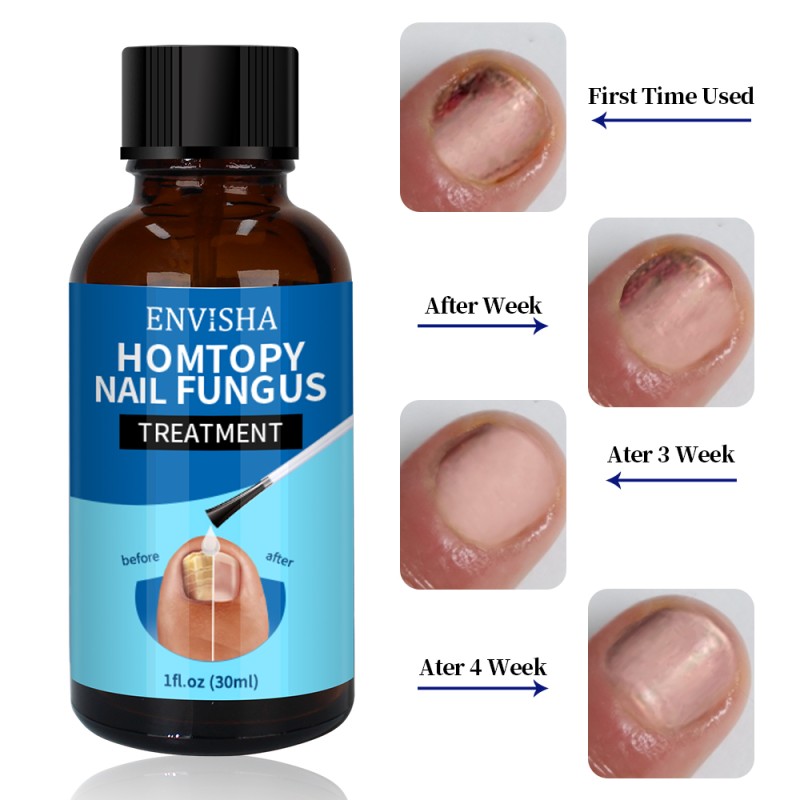 Nail Repair Serum Factory - Wholesale 30ml Fungal Nail Repair Serum Toenail Treatment Oil