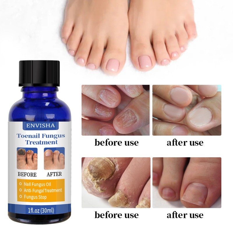 Nail Care Treatment Oil Manufacturer - Hot Sale Effectively Hand Feet Fungal Nail Repair Oil