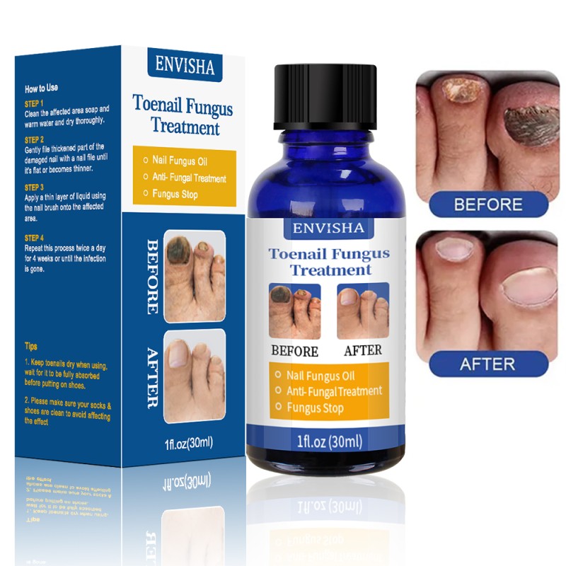 Nail Care Treatment Oil Manufacturer - Hot Sale Effectively Hand Feet Fungal Nail Repair Oil