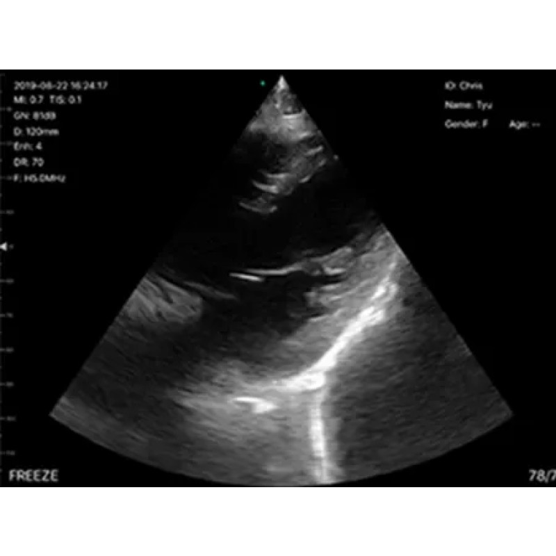 Handheld Ultrasound Manufacturer - Wireless Endovaginal Transducer