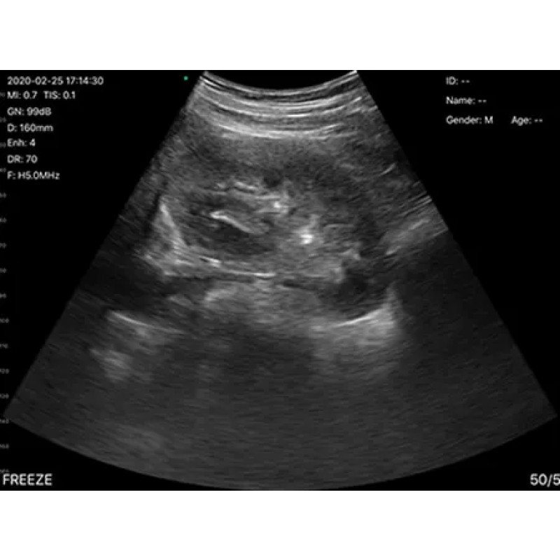 Handheld Ultrasound Manufacturer - Wireless Endovaginal Transducer