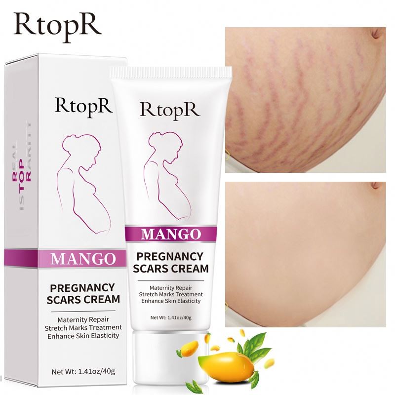 Oem Repair Remove Pregnancy Maternity Scars Treatment Body Skin Care Stretch Mark Cream