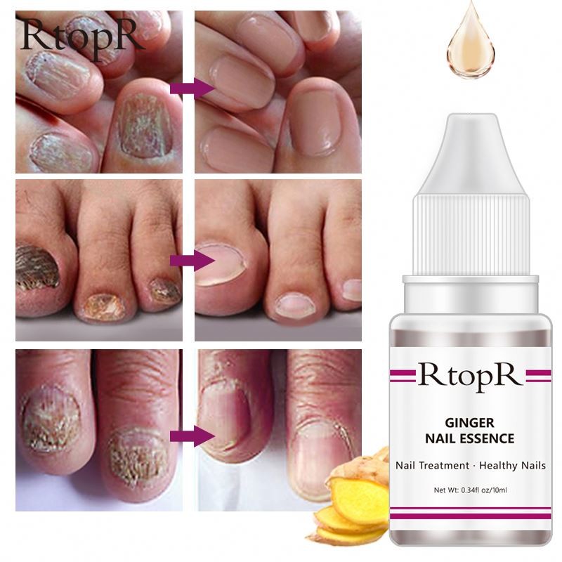 New Oem RtopR Liquid Repair Care Nutrient Solution Ginger Nail Essential Oil Anti-fungal Nourishing