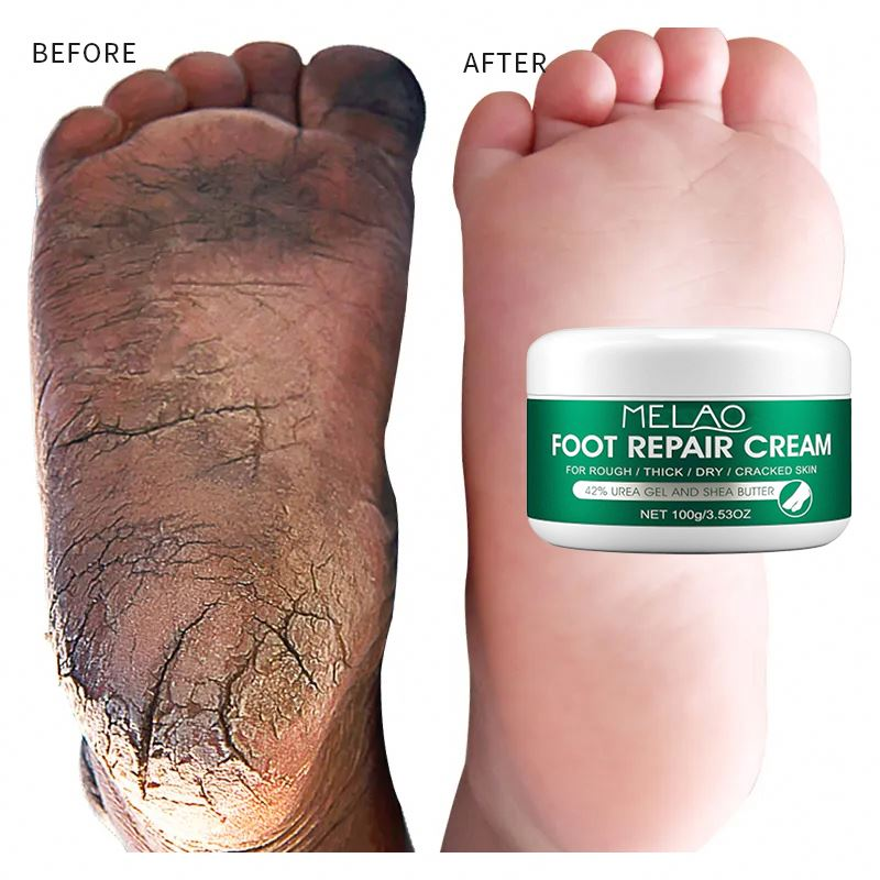 Oem Anti Fungal Scrub Exfoliation Dead Skin Removal Peeling Moisturizing Foot Care Repair Cream for Cracked Heels