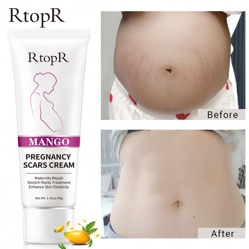 Oem Repair Remove Pregnancy Maternity Scars Treatment Body Skin Care Stretch Mark Cream