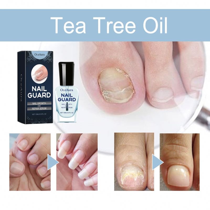 Fungal Treatment Feet Essence Anti Infection Onychomycosis Removal Toe Foot Fungus Paronychia Nail Care Body