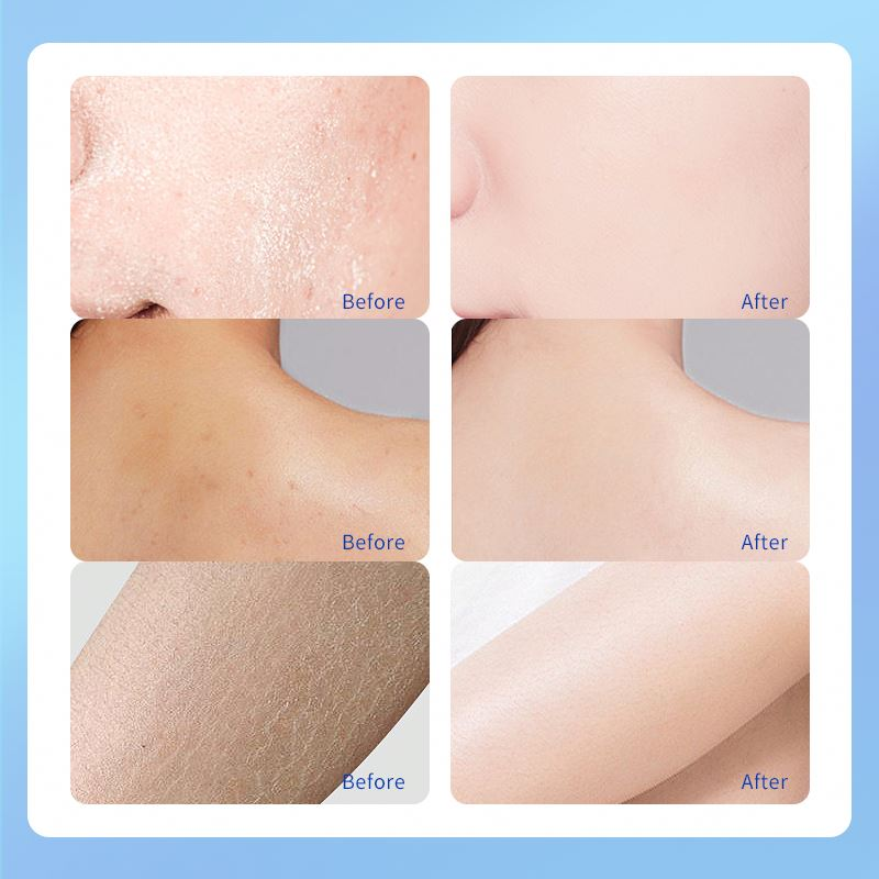 factory Oem Custom Anti Fungal Repair Foot Scrub Exfoliation Dead Skin Removal Peeling Moisturizing 40% Urea Hand Cream for Cracked Heels