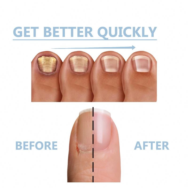Fungal Treatment Feet Essence Anti Infection Onychomycosis Removal Toe Foot Fungus Paronychia Nail Care Body