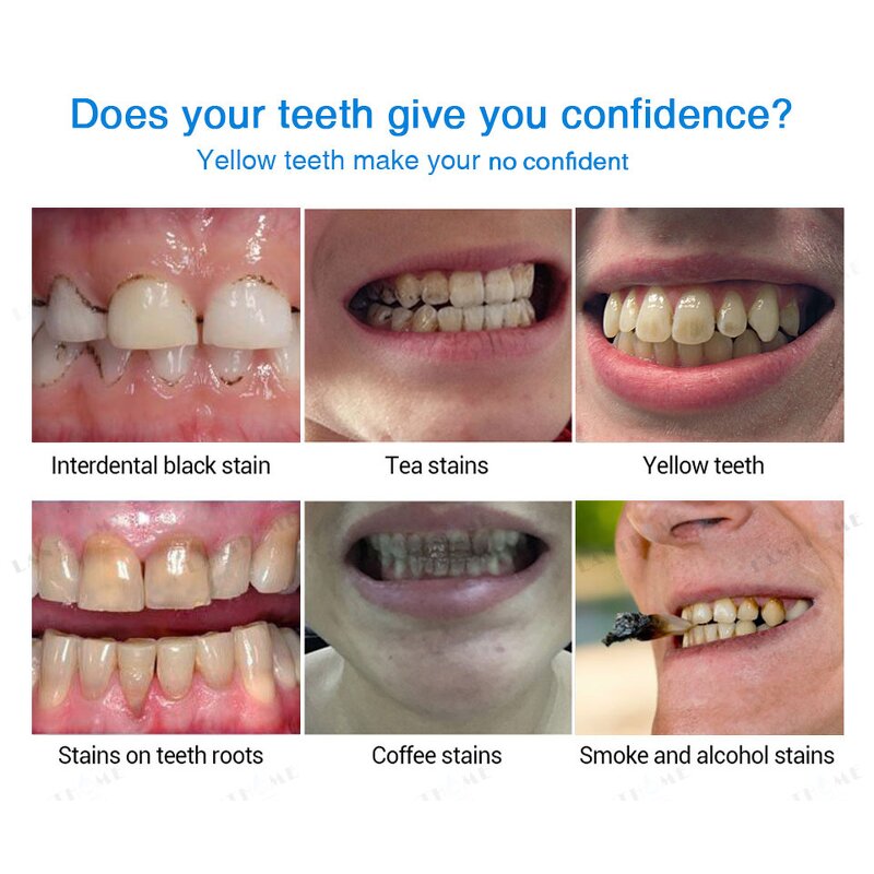 Teeth Whitening Pen Factory - Plastic Pen for Removing Yellow Stains