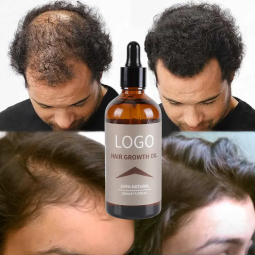 Hair Regrowth Oil Factory - OEM 30ml Ginger Rosemary Tea Tree